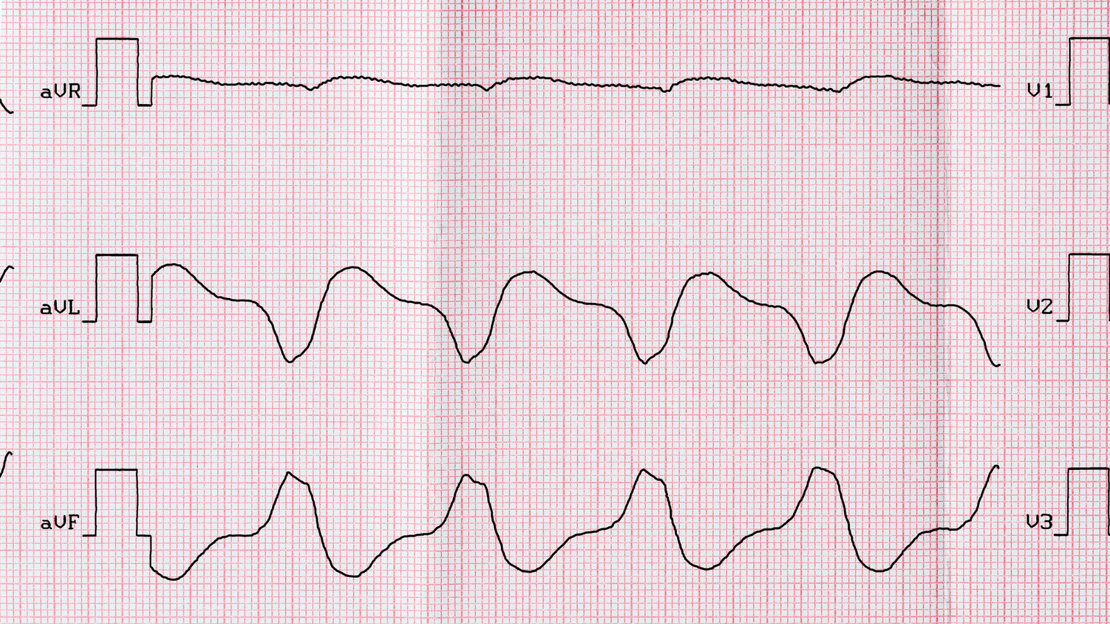 Ventricular Septal Defect (VSD)